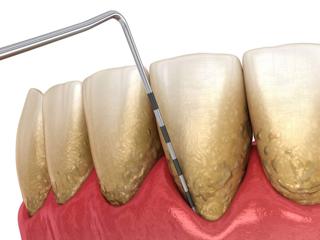 Gum Disease Treatment